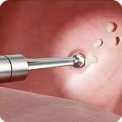 Spherical tip gently lifting a tonsil stone
