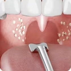 Tongue depressor tip