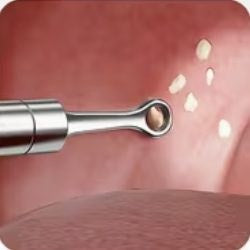 Ring tip